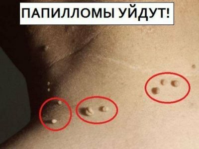Папилломы слезут уже к утру, паразиты вылетят комом, если втирать обычную…